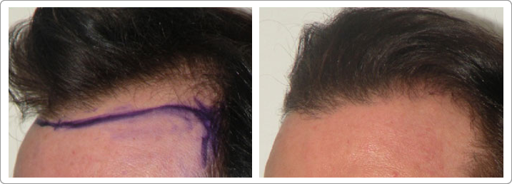 Hair Transplantations NYC, Hair Restorations NYC | Hair Loss